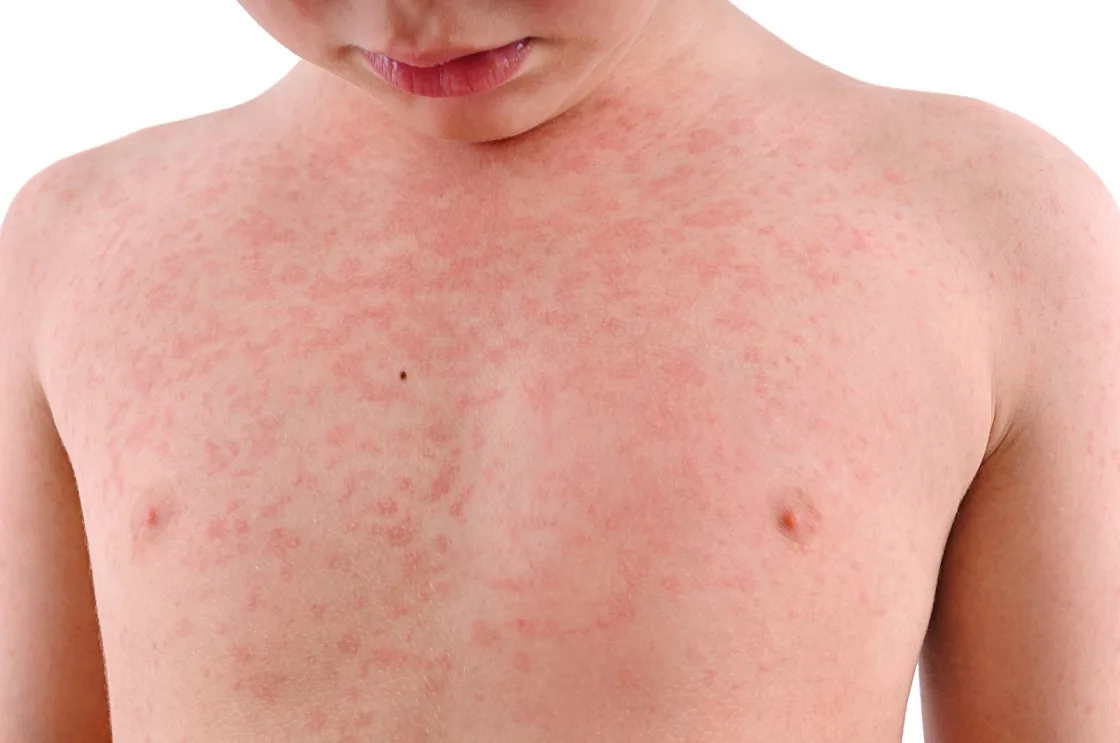 When to Worry About Rash on Child